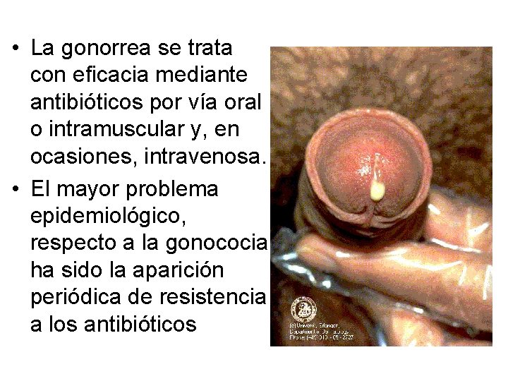  • La gonorrea se trata con eficacia mediante antibióticos por vía oral o