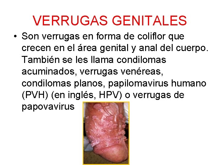 VERRUGAS GENITALES • Son verrugas en forma de coliflor que crecen en el área