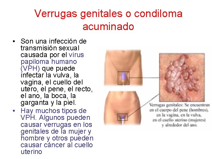 Verrugas genitales o condiloma acuminado • Son una infección de transmisión sexual causada por