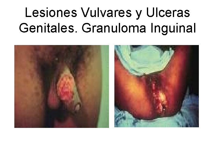 Lesiones Vulvares y Ulceras Genitales. Granuloma Inguinal 