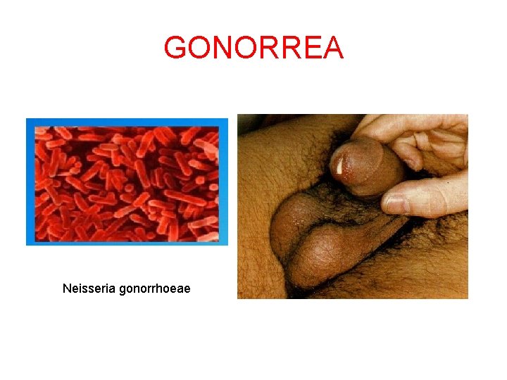 GONORREA Neisseria gonorrhoeae 