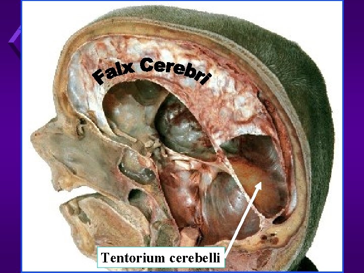 Tentorium cerebelli 