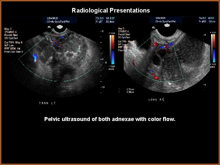 Radiological Presentations Pelvic ultrasound of both adnexae with color flow. 