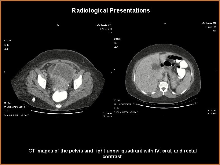 Radiological Presentations CT images of the pelvis and right upper quadrant with IV, oral,