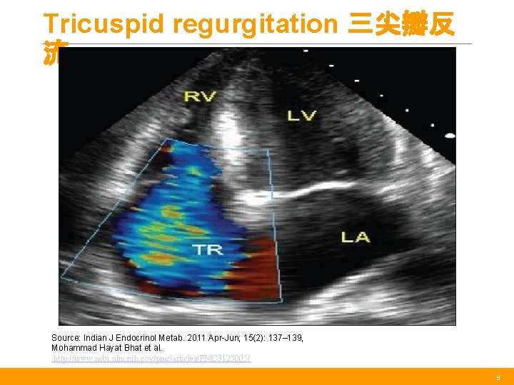 Tricuspid regurgitation 三尖瓣反 流 Source: Indian J Endocrinol Metab. 2011 Apr-Jun; 15(2): 137– 139,