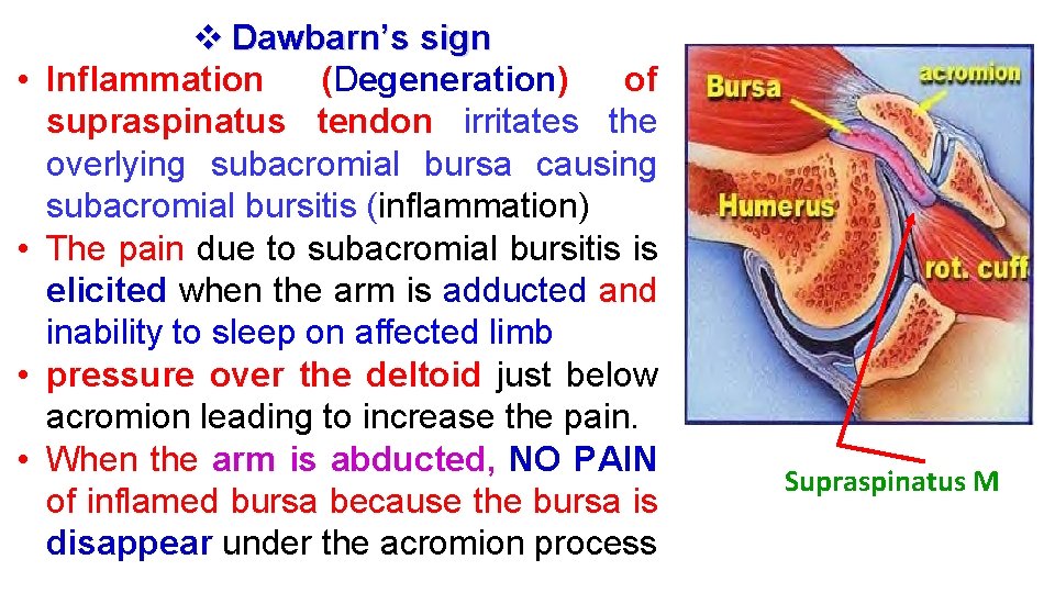 • • v Dawbarn’s sign Inflammation (Degeneration) of supraspinatus tendon irritates the overlying • • v Dawbarn’s sign Inflammation (Degeneration) of supraspinatus tendon irritates the overlying
