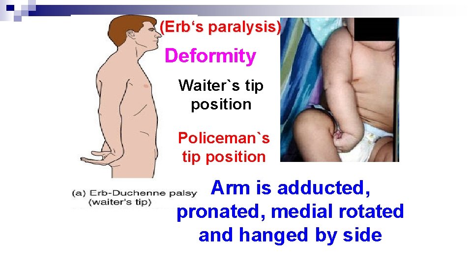 (Erb‘s paralysis) Deformity Waiter`s tip position Policeman`s tip position Arm is adducted, pronated, medial (Erb‘s paralysis) Deformity Waiter`s tip position Policeman`s tip position Arm is adducted, pronated, medial
