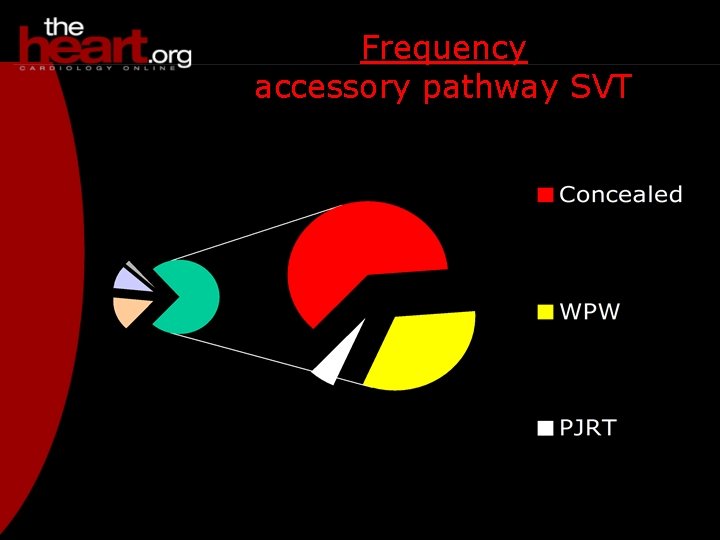 Frequency accessory pathway SVT 