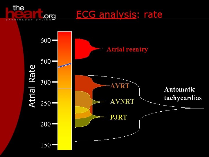 ECG analysis: rate 600 Atrial Rate Atrial reentry 500 300 AVRT 250 AVNRT 200