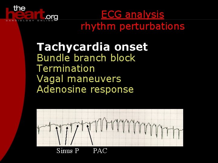 ECG analysis rhythm perturbations Tachycardia onset Bundle branch block Termination Vagal maneuvers Adenosine response