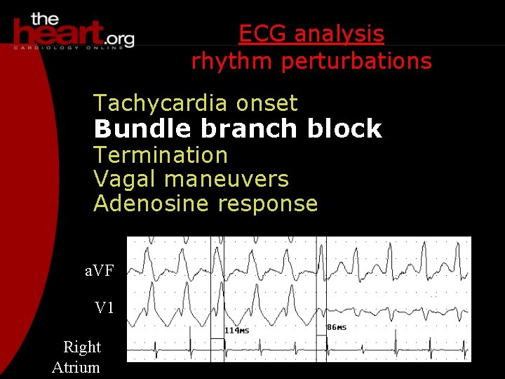 ECG analysis rhythm perturbations Tachycardia onset Bundle branch block Termination Vagal maneuvers Adenosine response