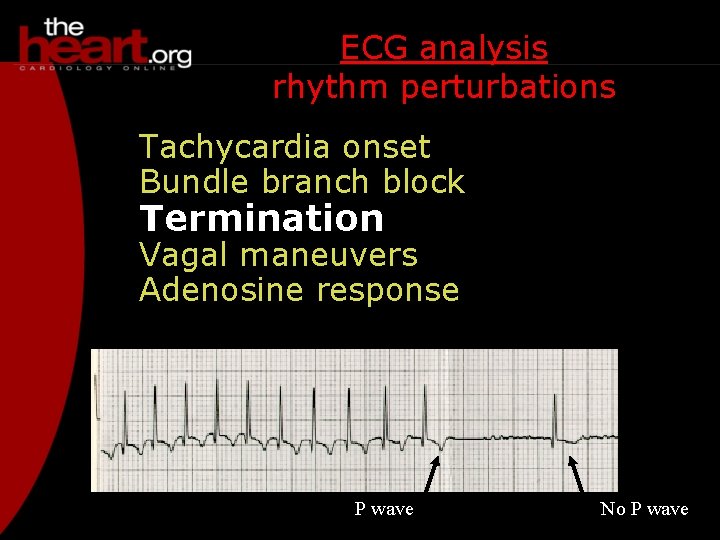 ECG analysis rhythm perturbations Tachycardia onset Bundle branch block Termination Vagal maneuvers Adenosine response