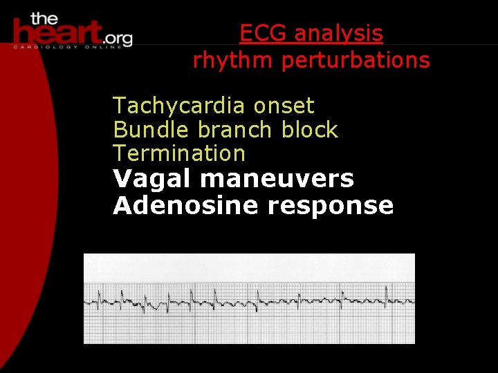 ECG analysis rhythm perturbations Tachycardia onset Bundle branch block Termination Vagal maneuvers Adenosine response