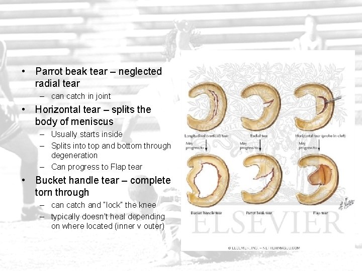  • Parrot beak tear – neglected radial tear – can catch in joint