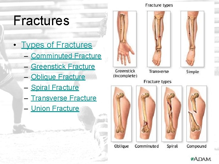 Fractures • Types of Fractures – – – Comminuted Fracture Greenstick Fracture Oblique Fracture