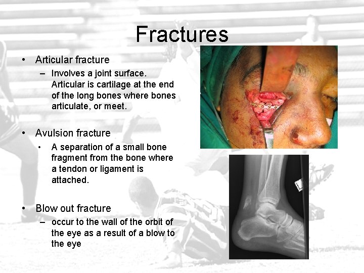 Fractures • Articular fracture – Involves a joint surface. Articular is cartilage at the