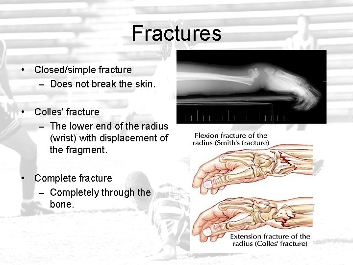 Fractures • Closed/simple fracture – Does not break the skin. • Colles' fracture –