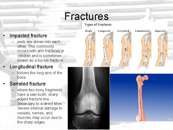 Fractures • Impacted fracture – ends are driven into each other. This commonly occurs