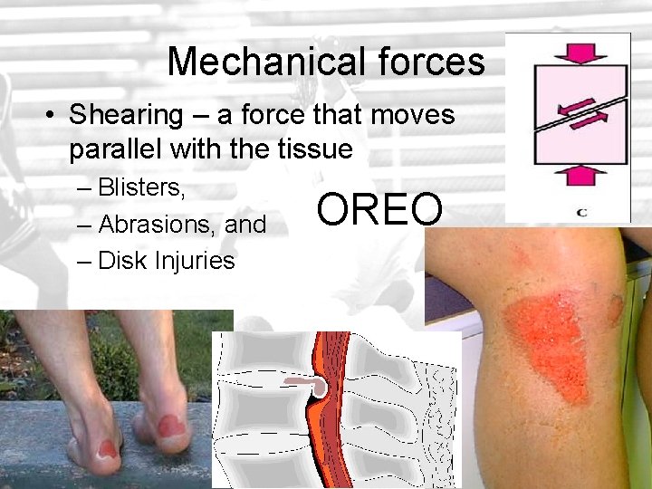 Mechanical forces • Shearing – a force that moves parallel with the tissue –