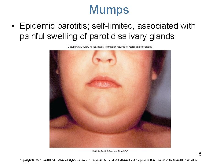 Mumps • Epidemic parotitis; self-limited, associated with painful swelling of parotid salivary glands 15