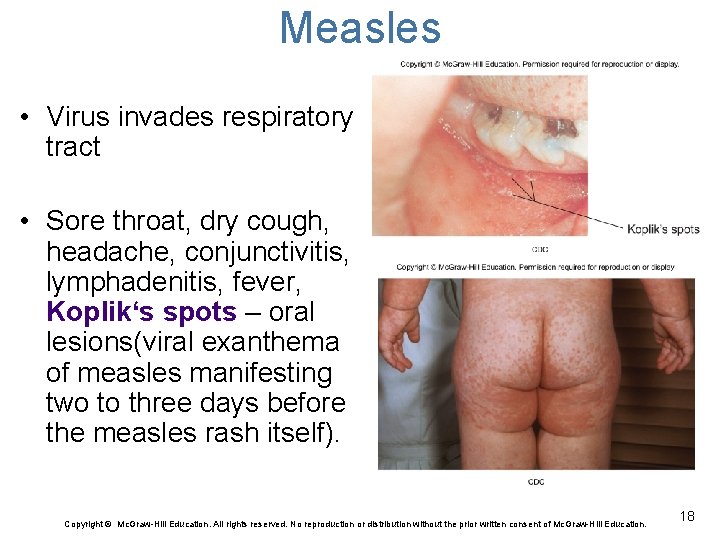 Measles • Virus invades respiratory tract • Sore throat, dry cough, headache, conjunctivitis, lymphadenitis,