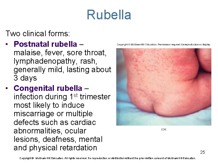 Rubella Two clinical forms: • Postnatal rubella – malaise, fever, sore throat, lymphadenopathy, rash,