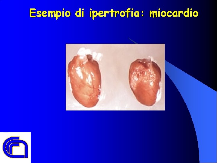 Esempio di ipertrofia: miocardio ” 