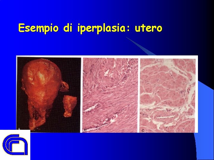 Esempio di iperplasia: utero 