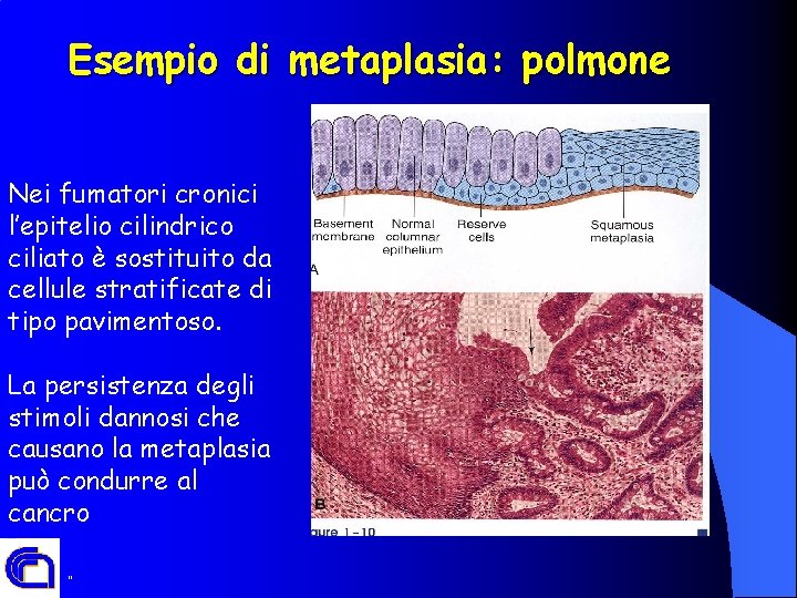 Esempio di metaplasia: polmone Nei fumatori cronici l’epitelio cilindrico ciliato è sostituito da cellule