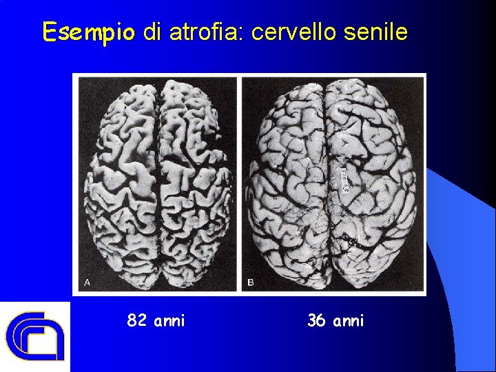 Esempio di atrofia: cervello senile 82 anni 36 anni 