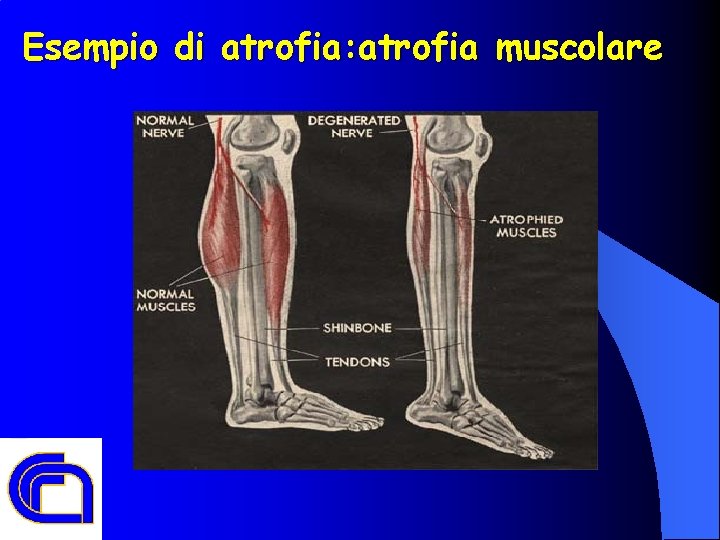 Esempio di atrofia: atrofia muscolare 