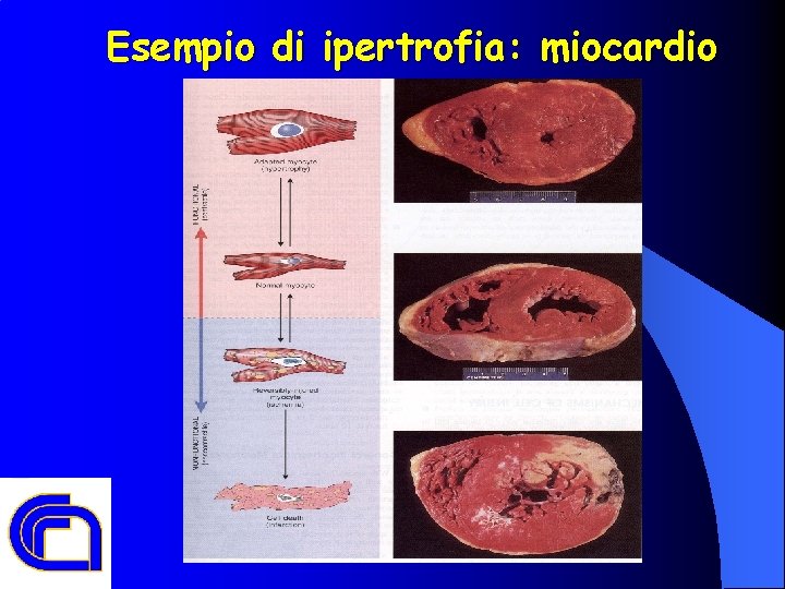 Esempio di ipertrofia: miocardio 