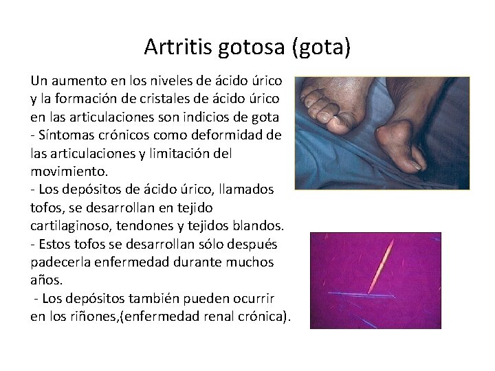 Artritis gotosa (gota) Un aumento en los niveles de ácido úrico y la formación