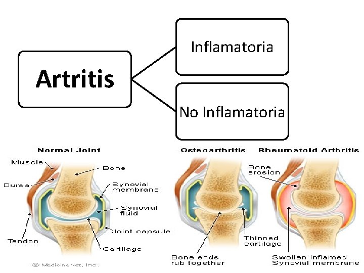 Inflamatoria Artritis No Inflamatoria 
