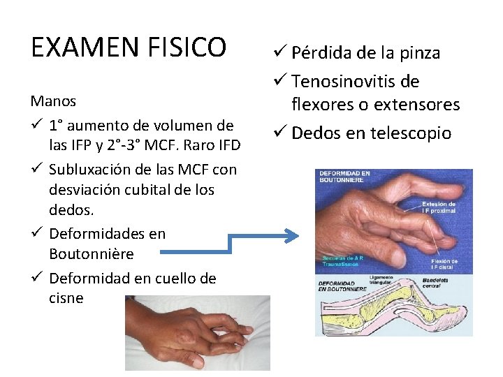 EXAMEN FISICO Manos ü 1° aumento de volumen de las IFP y 2°-3° MCF.