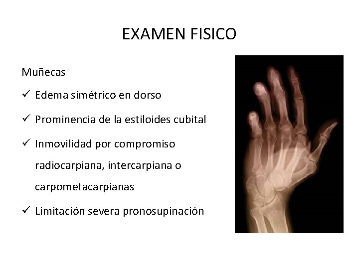 EXAMEN FISICO Muñecas ü Edema simétrico en dorso ü Prominencia de la estiloides cubital