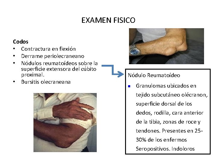 EXAMEN FISICO Codos • Contractura en flexión • Derrame periolecraneano • Nódulos reumatoídeos sobre