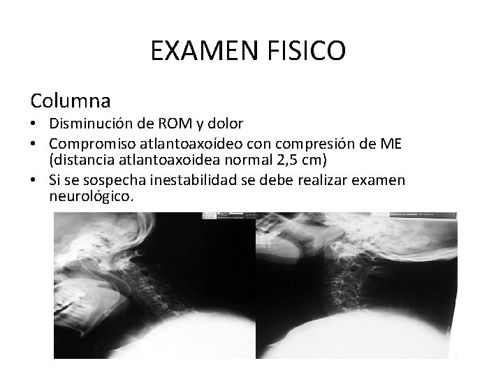 EXAMEN FISICO Columna • Disminución de ROM y dolor • Compromiso atlantoaxoídeo con compresión