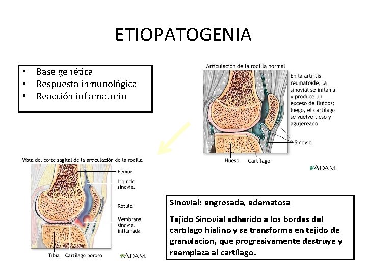 ETIOPATOGENIA • Base genética • Respuesta inmunológica • Reacción inflamatorio Sinovial: engrosada, edematosa Tejido