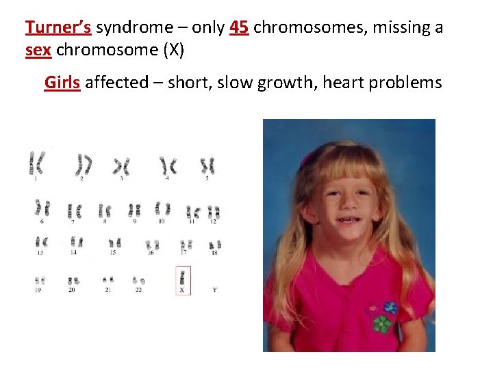 Turner’s syndrome – only 45 chromosomes, missing a sex chromosome (X) Girls affected –