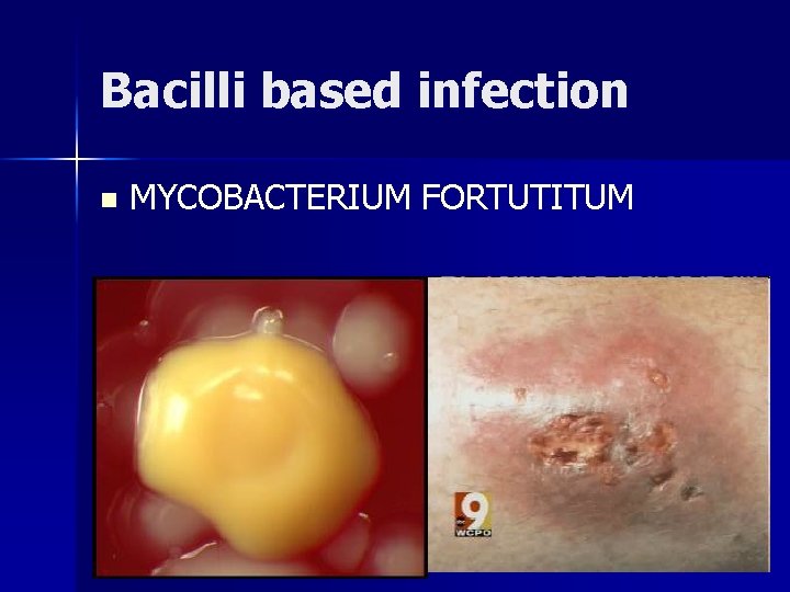 Bacilli based infection n MYCOBACTERIUM FORTUTITUM Bacilli based infection n MYCOBACTERIUM FORTUTITUM