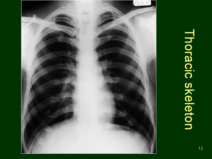 Thoracic skeleton 12 