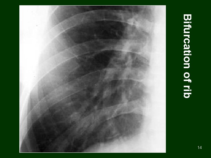 Bifurcation of rib 14 