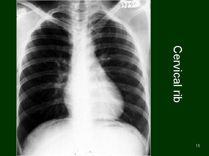 Cervical rib 15 