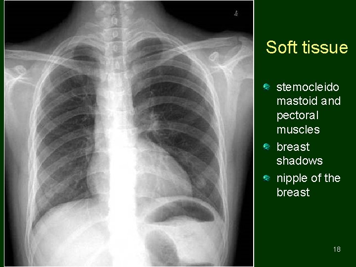 Soft tissue stemocleido mastoid and pectoral muscles breast shadows nipple of the breast 18