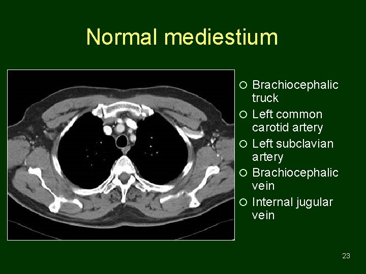 Normal mediestium ¡ Brachiocephalic ¡ ¡ truck Left common carotid artery Left subclavian artery