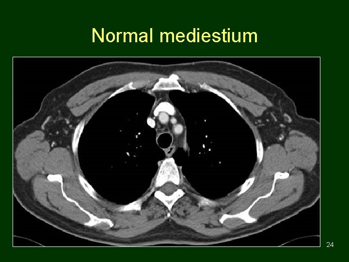 Normal mediestium 24 