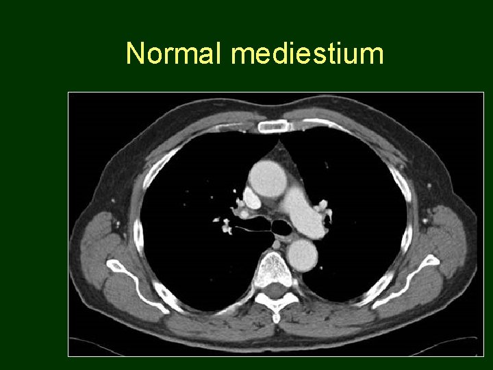 Normal mediestium 27 