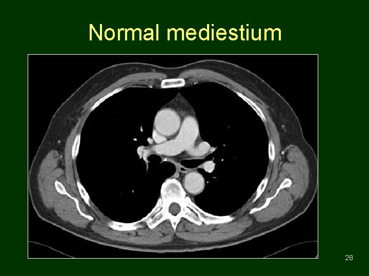 Normal mediestium 28 