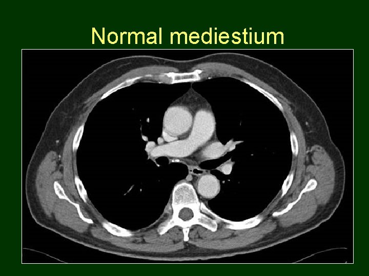 Normal mediestium 29 